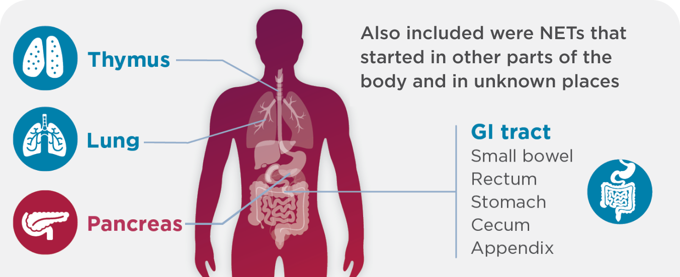 Text: Also included were NETs that started in other parts of the body and in unknown places. Diagram of a person's body pointing to the thymus, lung, pancreas and GI tract which includes small bowel, rectum, stomach, cecum, and appendix. 