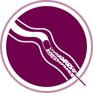 CABOMETYX Blood Vessel blockage icon